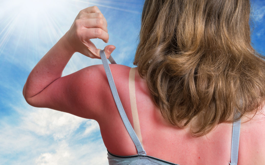 Eine Frau steht in freiem unter blauem Himmel. Ihr Rücken und die Schultern weisen einen starken Sonnenbrand auf.