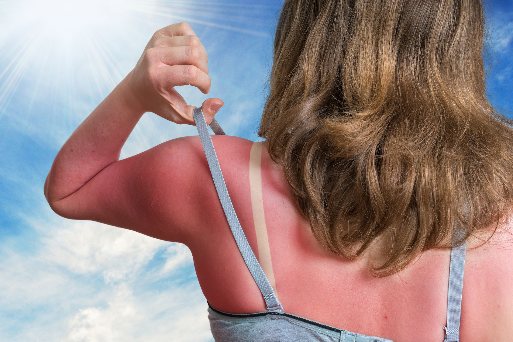 Eine Frau steht in freiem unter blauem Himmel. Ihr Rücken und die Schultern weisen einen starken Sonnenbrand auf.