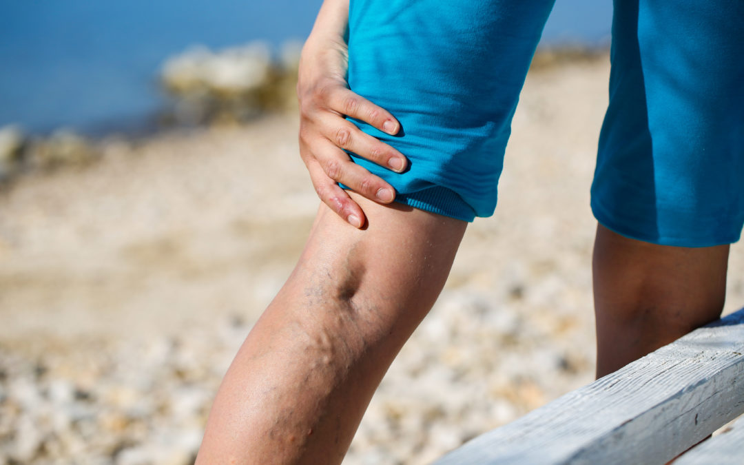 Eine Frau geht am Strand spazieren und hält sich schmerzvoll die Venen auf ihrem Bein. (Venenerkrankungen)